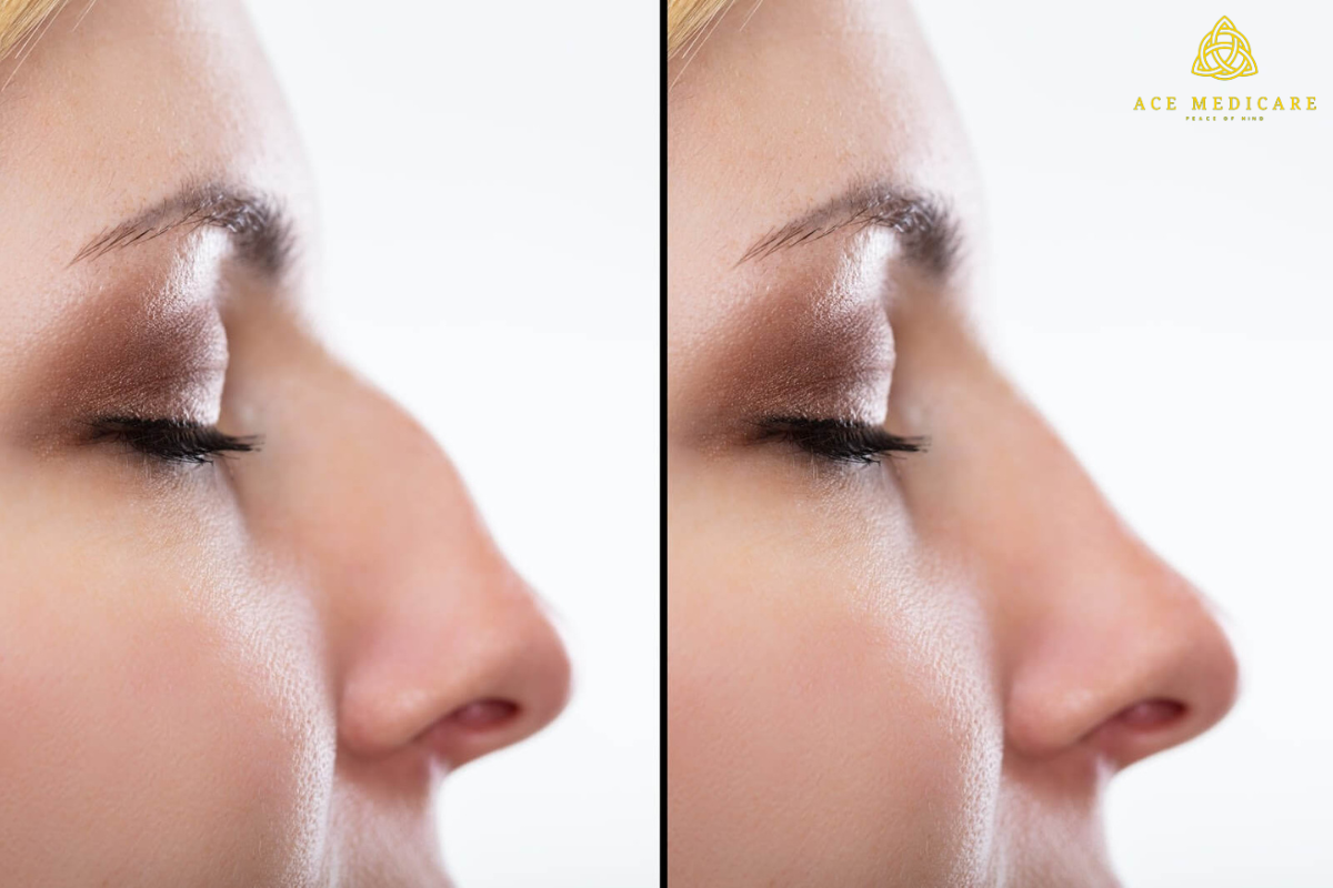 The Dos and Don'ts of Rhinoplasty: Expert Advice for a Successful Procedure